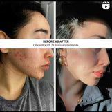 Lumara - VISO - Anti-Aging Red Light Mask