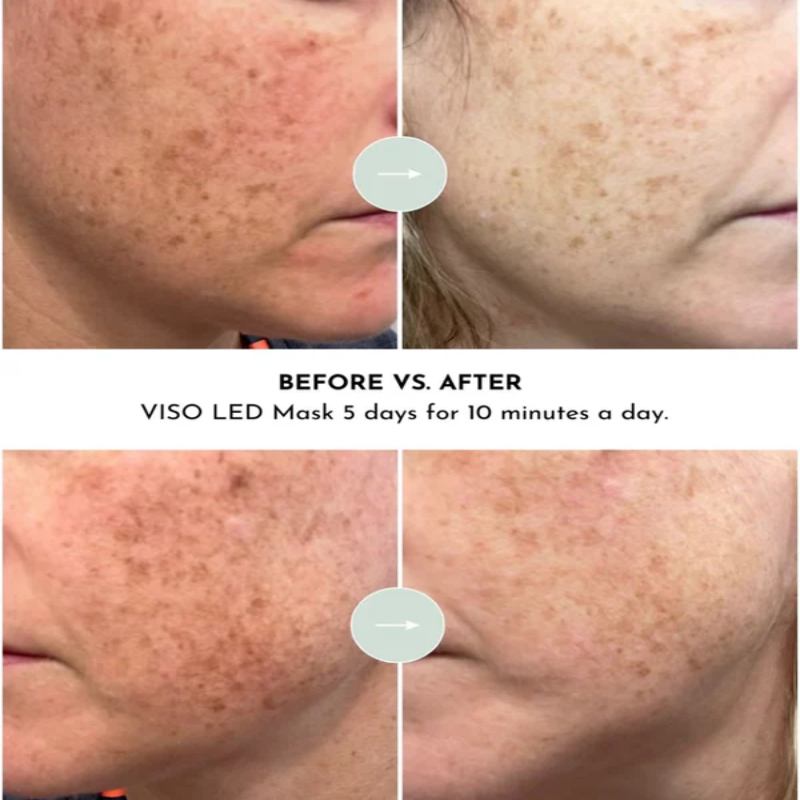 Lumara - VISO - Anti-Aging Red Light Mask